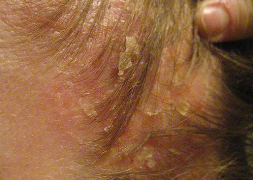 Miten parantaa seborrheic dermatiitti?