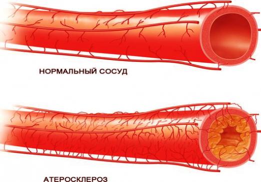 Mikä on ateroskleroosi?